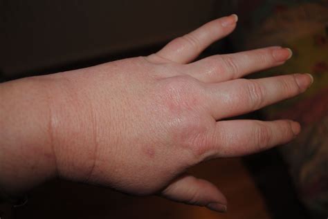 Swollen painfull hands. Crohns or medication | Crohns, Fibromyalgia, Medical