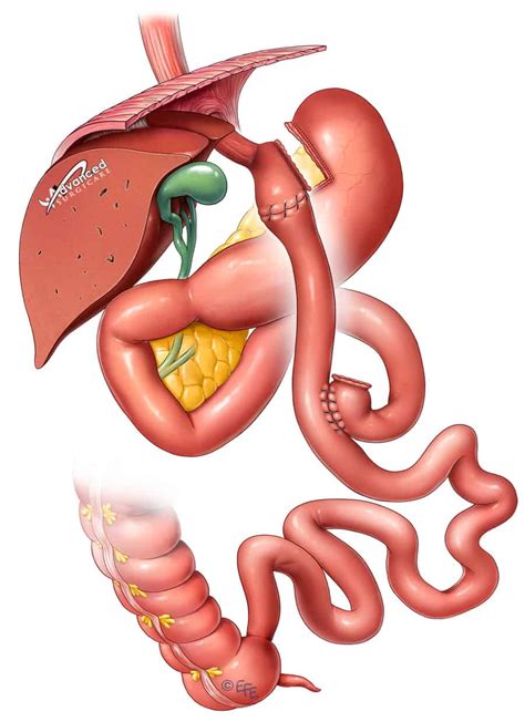 Gastric Bypass Surgery - Pictures