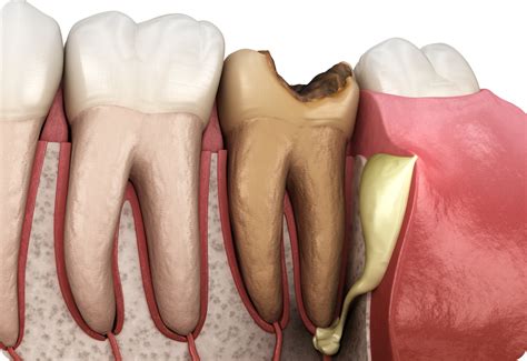 Pulp Necrosis or Dental Gangrene: Causes, Treatment