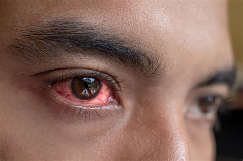 Is Your Pink Eye a Symptom of COVID-19? | Atlantic Eye Institute
