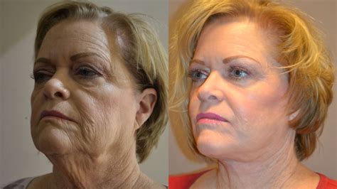 Facial Plastic Surgery Innovations Lead to the Best Facelift Results - LookYounger.News