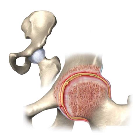 Transient Synovitis Hip - Symptoms, causes and treatment