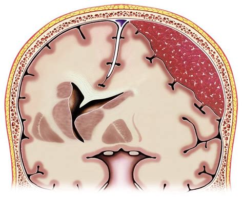 Subdural Hematoma Causes Symptoms Treatment Study | The Best Porn Website