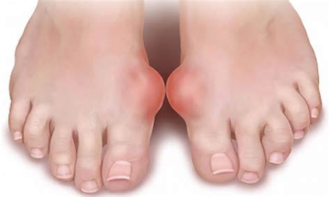 Gut Hastalığı Nedir? Natural Gout Treatment, Arthritis Treatment, Eczema Treatment, Home ...