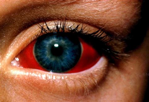 Subconjunctival hemorrhage