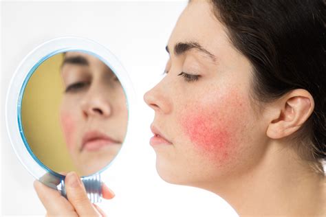 Rosacea: Symptoms and Treatment | Saber Healthcare