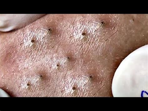 videos blackheads removal satisfying and large popping pimples NASA SPA sacdepspa Sandra lee ...