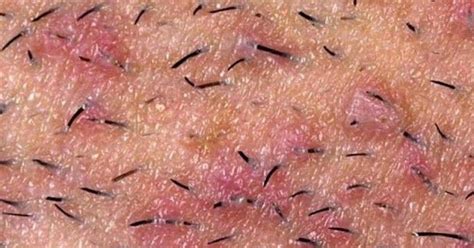 Razor bumps are also known as pseudofolliculitis barbae technically which are actually ingrown ...