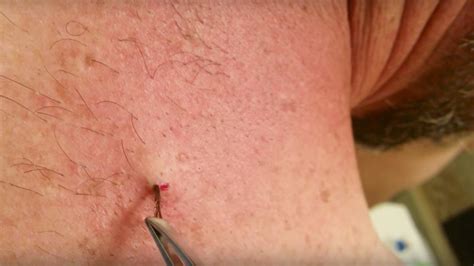 This Viral Video of a Six-Year-Old Ingrown Hair Being Removed Is ...