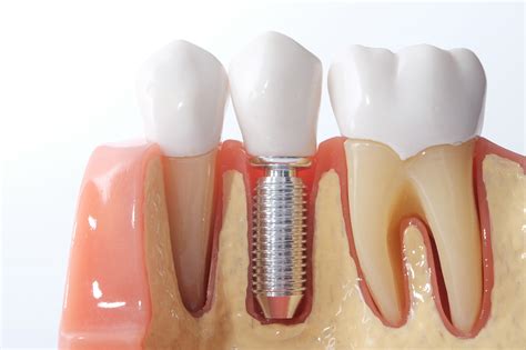 What Are the Different Types of Dental Implants?