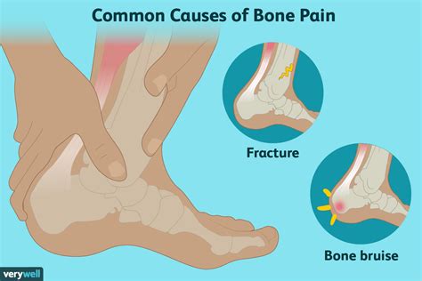 Why Are You Experiencing Bone Pain? (2022)