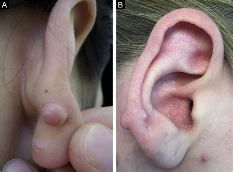 Keloid formation following ear piercing through the transitional zone ...