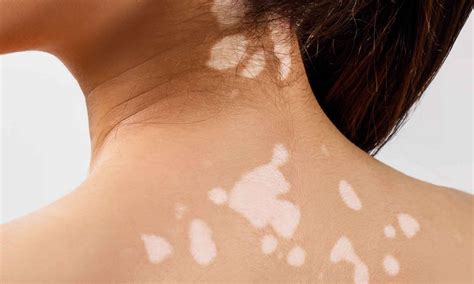 Skin discoloration causes and dark or white skin discoloration treatment