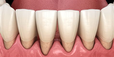 Receding Gums - Eastern Dental