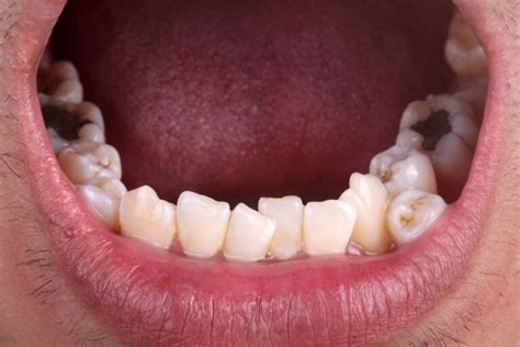 Hyperdontia- Symptoms, Causes, and Treatment - Legit Option