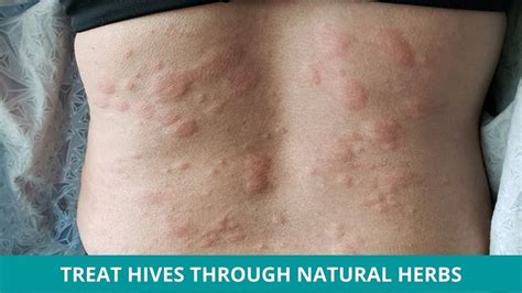 Can’t-Miss Takeaways Of Tips About How To Prevent Hives - Delaybeat