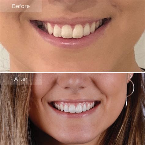 Invisalign Before And After Crowding