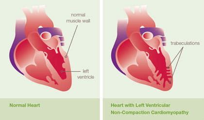 Left Ventricular Non-Compaction Cardiomyopathy (LVNC) | Pediatric Cardiomyopathy