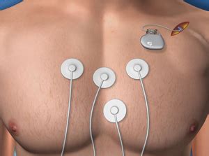 Pacemaker Implantation (Endocardial Approach)