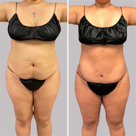 Liposuction Before and After Photos: What You Can Really Expect, Say ...