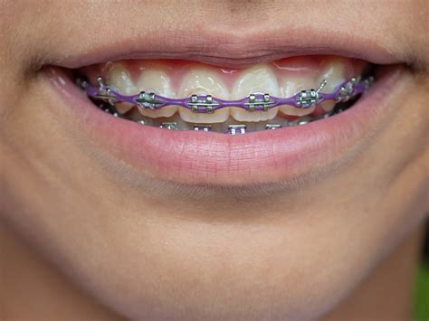 How Long Does It Take For Braces To Straighten Teeth? - General and Cosmetic Dentistry ...