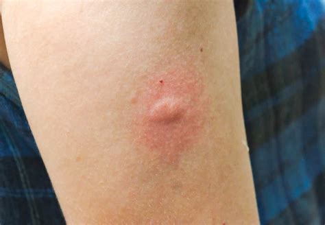 Mosquito Bites Pictures Allergic Reaction