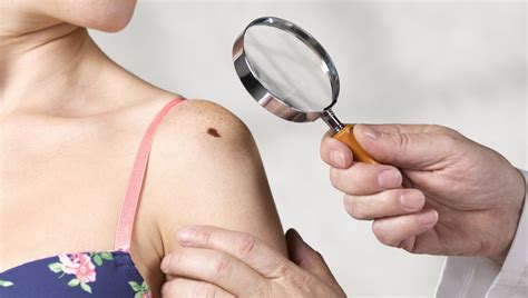 'Save your Skin', the skin cancer prevention campaign - Breaking Latest News