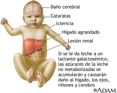 Galactosemia: MedlinePlus enciclopedia médica illustración