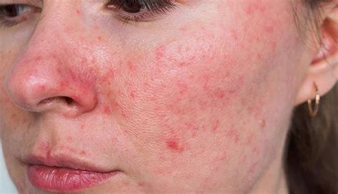 8 Effective Home Remedies to Alleviate Rosacea Symptoms - lifeberrys.com