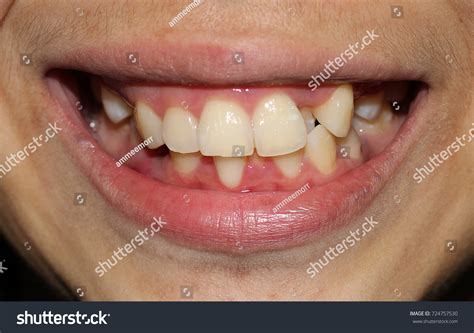 1,388 Crooked teeth adult Images, Stock Photos & Vectors | Shutterstock