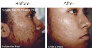 Vitalize Peel - Glen Town Center Glenview, IL & Highland Park, IL: Skin Deep Medical Spa