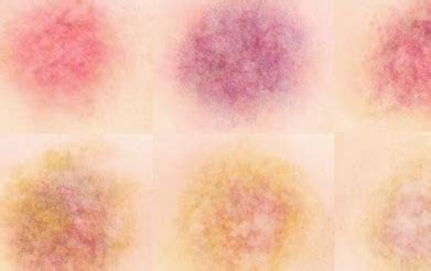 Different Stages of Bruising Colors, Pictures and Chart | Hematomas ...