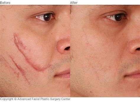 Scar Revision Before & After Photos | Dr. Benjamin Bassichis
