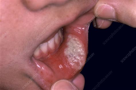 Canker sore - Stock Image - C052/2063 - Science Photo Library