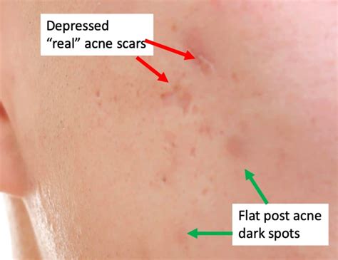 Very Mild Acne Scars