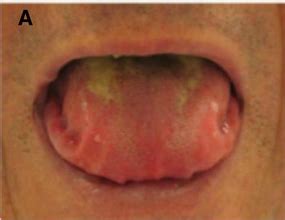 Macroglossia Article