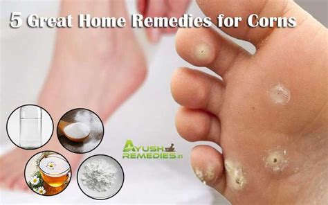 Effective Home Remedies for Corns