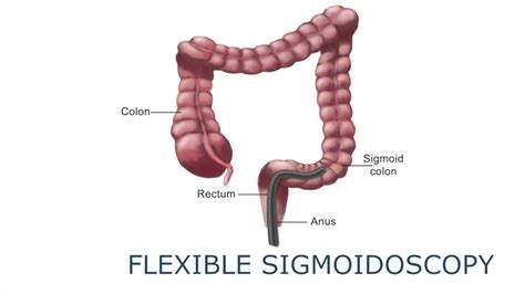 Flexible sigmoidoscopy - YouTube