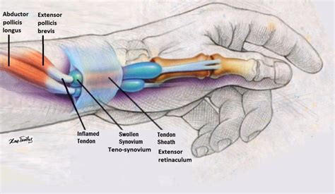 Figure_1_-_Tendons_of_the_abductor_pollicis_longus_and_extensor_pollicis_brevis_within_the ...
