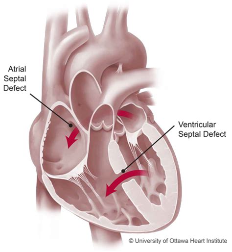 Congenital Heart Defects Diagram