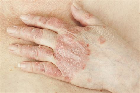 What You Need to Know About Psoriatic Arthritis - Keep Asking