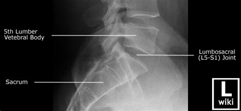 Lumbar Spine Radiographic Anatomy - wikiRadiography