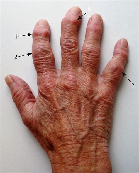 Arthritis Symptoms On Hands at Doris Greer blog