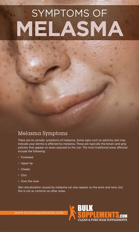 Melasma: Symptoms, Causes & Treatment