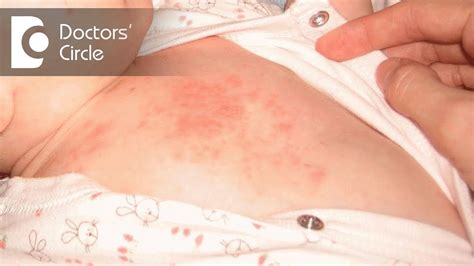 Itchy Rash On Stomach : Belly Button Rash: Causes & Symptoms | MedicaVerse : A rash is a ...