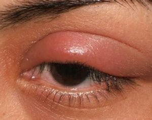 Swollen Eyelids: Causes, Pictures, Meaning, How to Get Rid, Cure ...