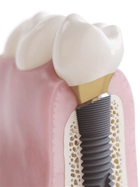 OsseoSpeed Profile EV (ASTRA TECH Implant System) - Dentsply Sirona ...