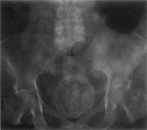 Treatment of an Impacted Fecalith with Electrohydraulic Lithotripsy | NEJM