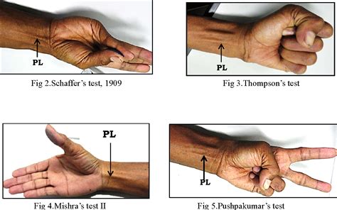 Palmaris Longus Test