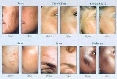 Microdermabrasion Blackheads Before And After